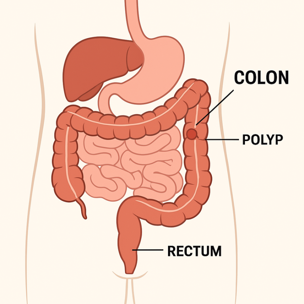 Educational illustration of the digestive system with labels for colon, rectum, and a small polyp